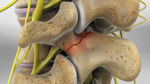 faset eklem blokajı