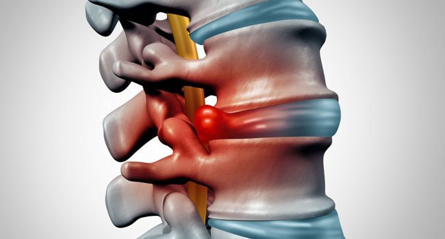 endoskopik omurga cerrahisi